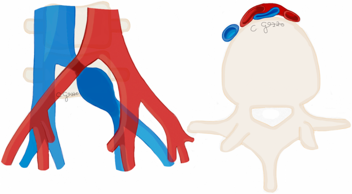 Ct imaging findings of abdominopelvic vascular pression syndromes what the radiologist needs to know insights into imaging full text